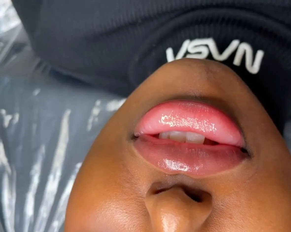 dark lip neutralization melbourne