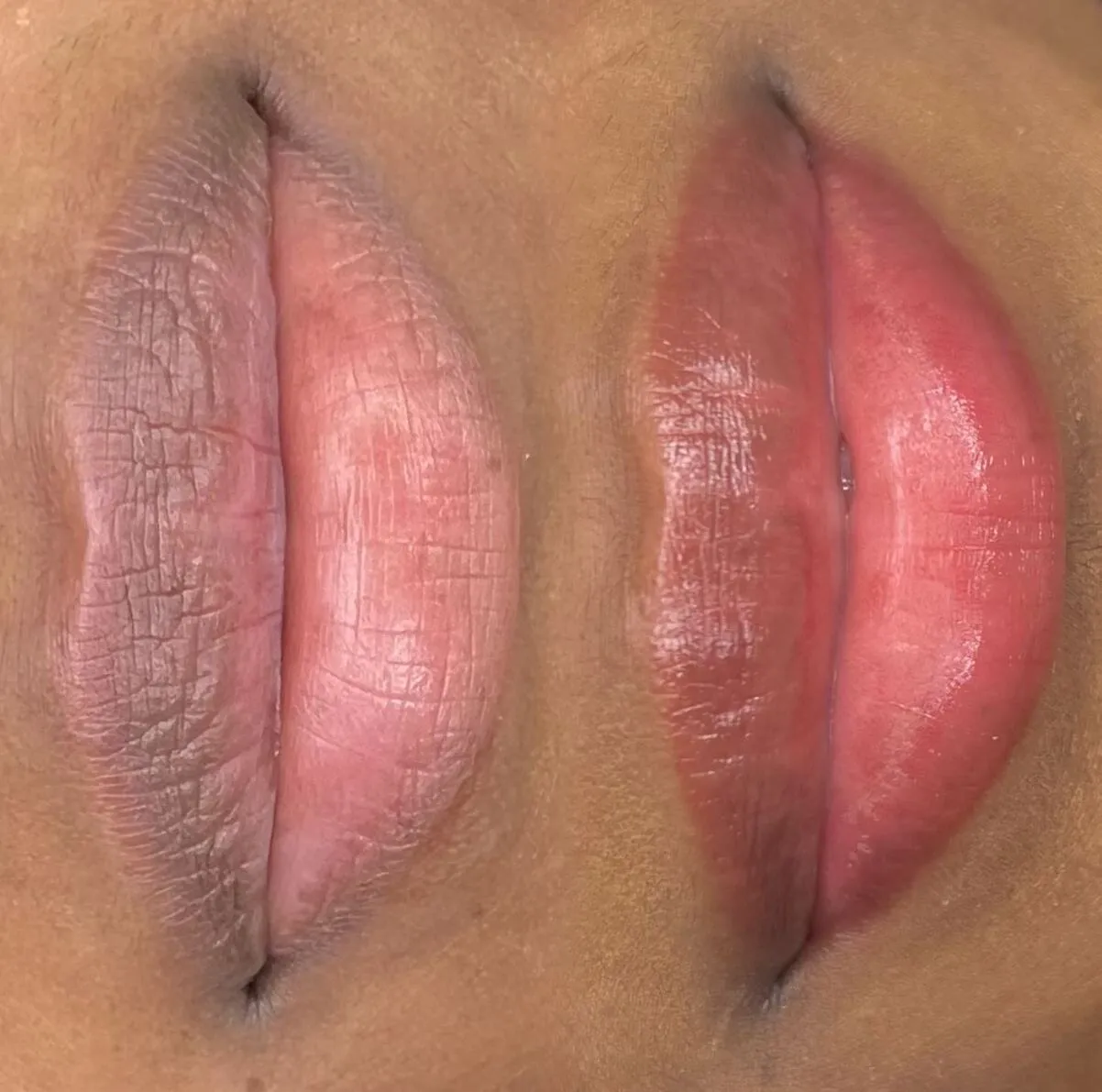 melbourne dark lip neutralization