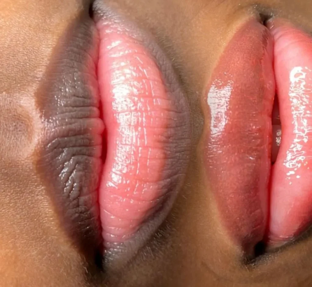 dark lip neutralization